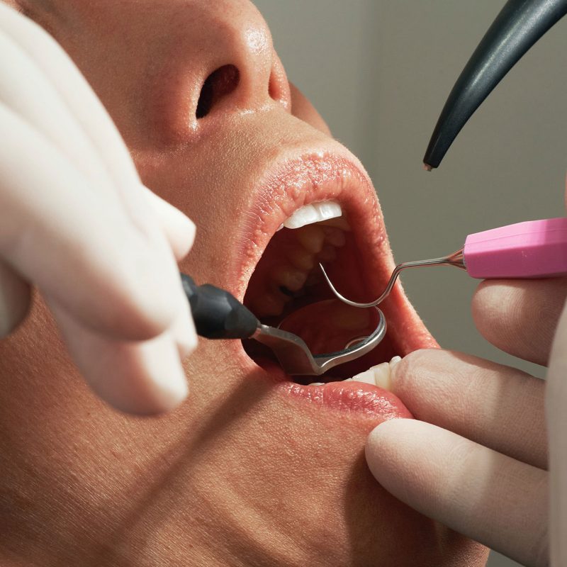 Complicaciones en cirugía maxilofacial: prevención y manejo