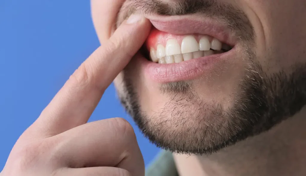 Prevención y tratamiento avanzado de la periodontitis en Barcelona
