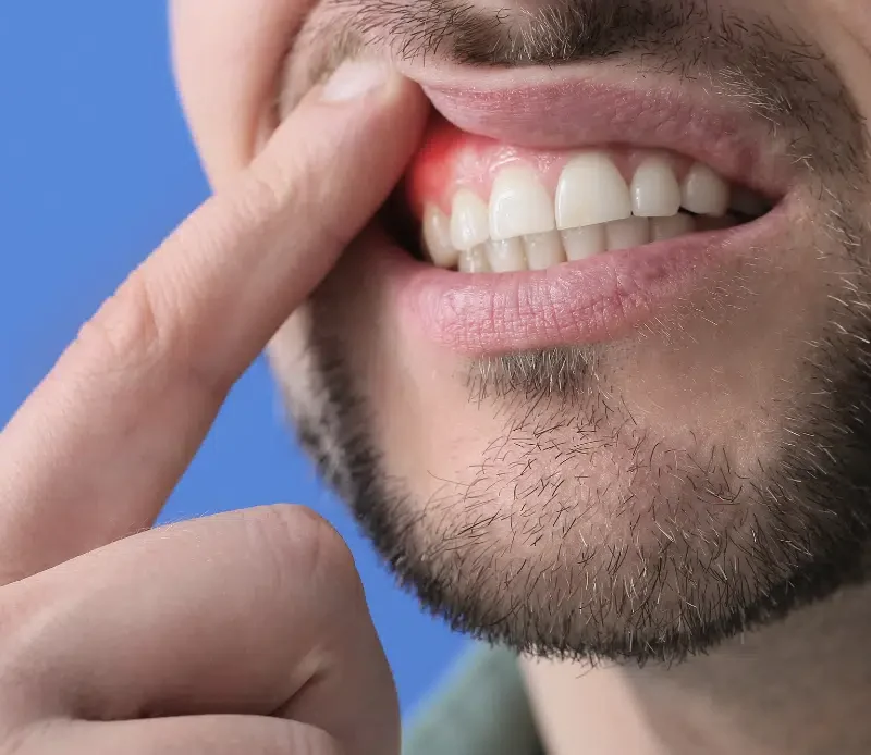 Prevención y tratamiento avanzado de la periodontitis en Barcelona