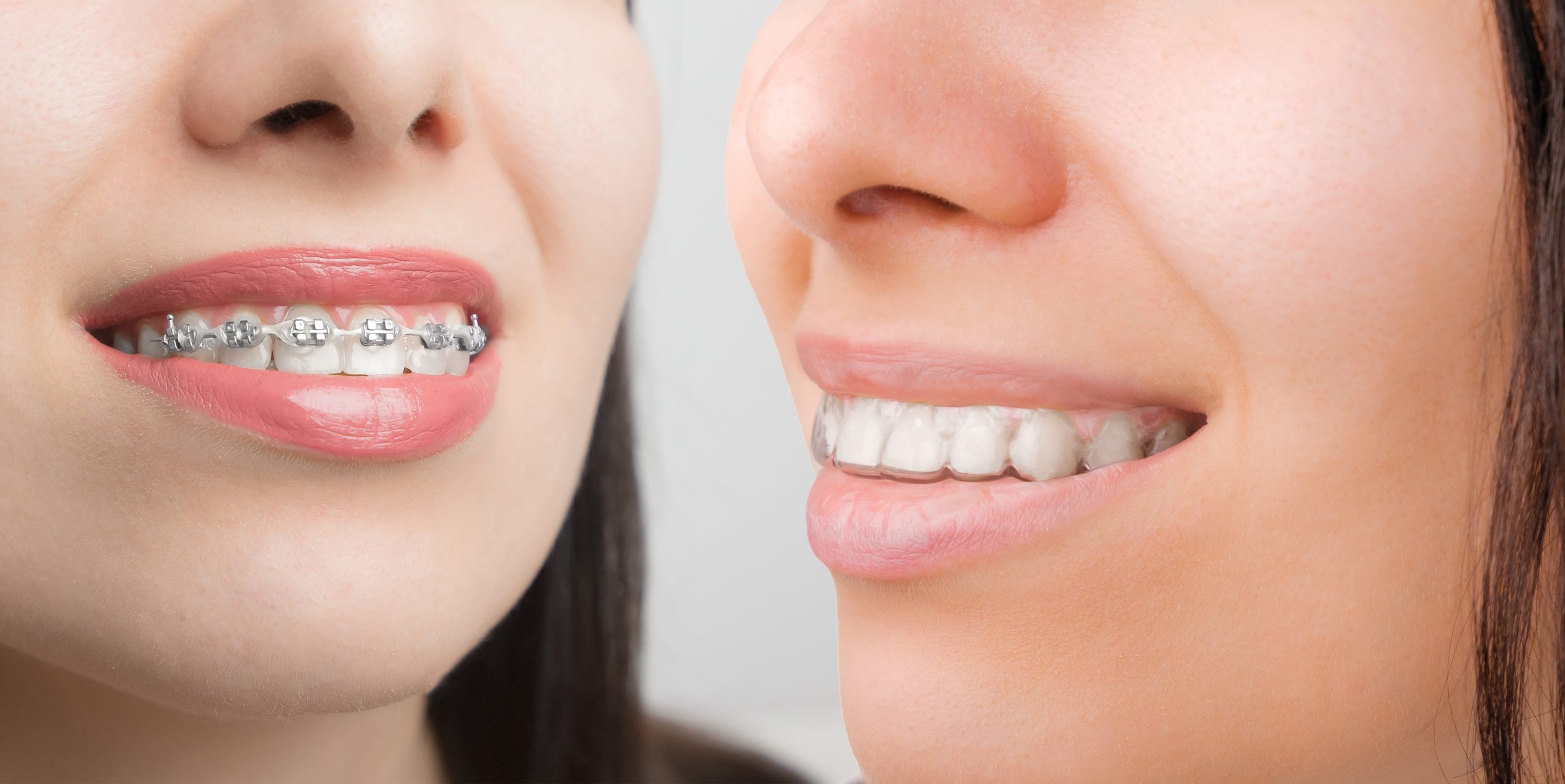 Comparativa de tratamientos: brackets vs. alineadores