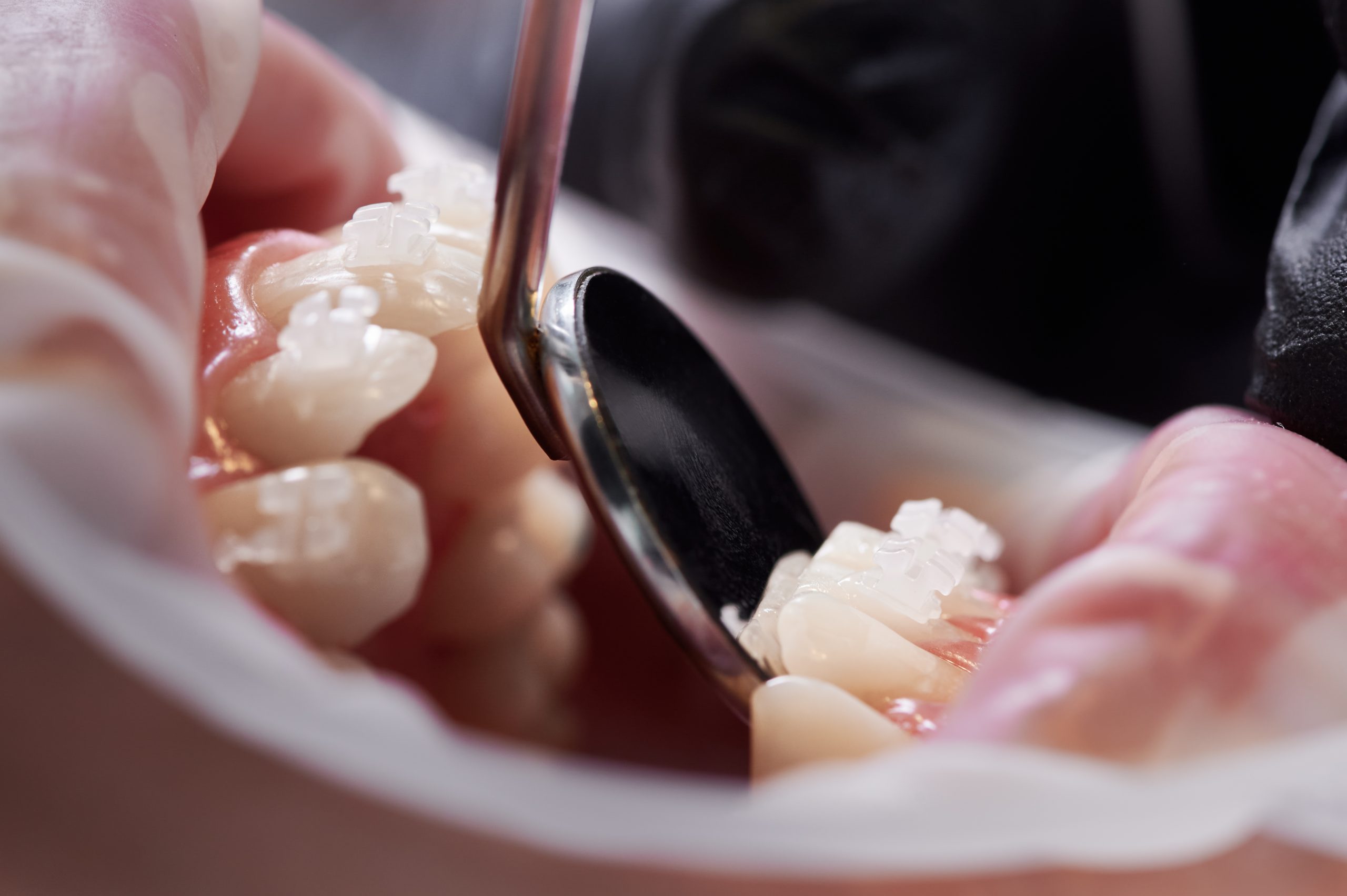 Lo último en estética dental: tendencias y tratamientos