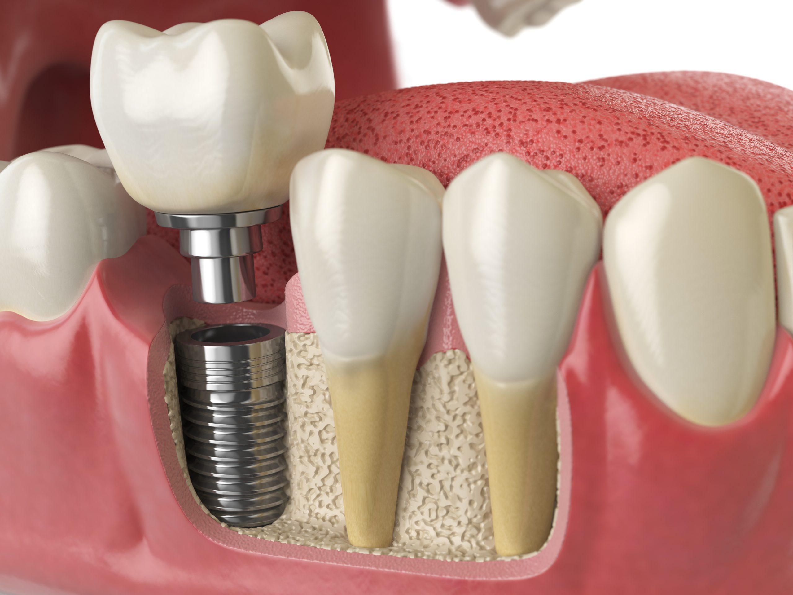 Implantología dental: soluciones modernas para la pérdida de dientes