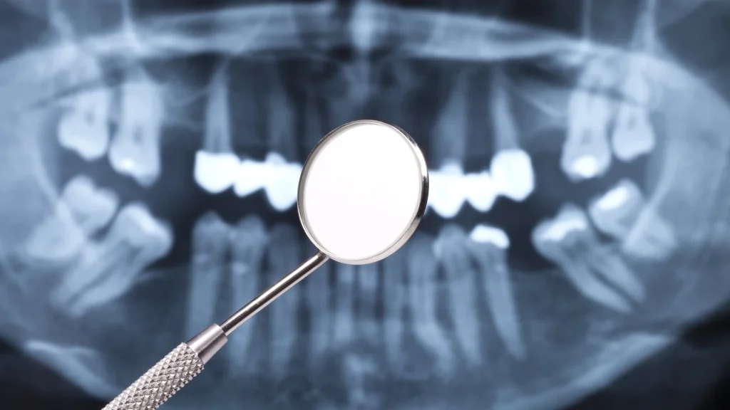 Avances en Odontología regenerativa con células madre
