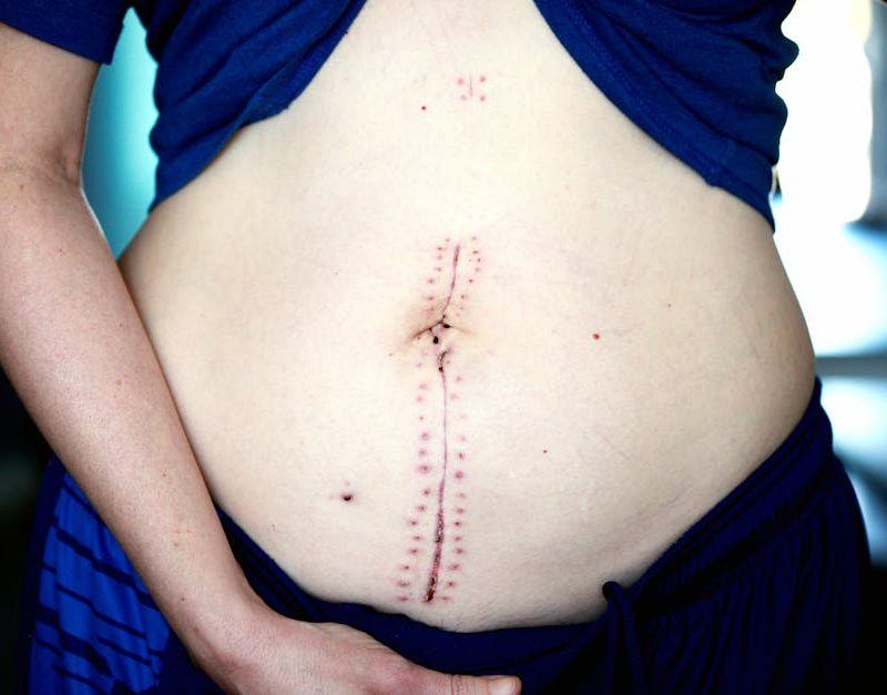 recuperación cirugía ortognática