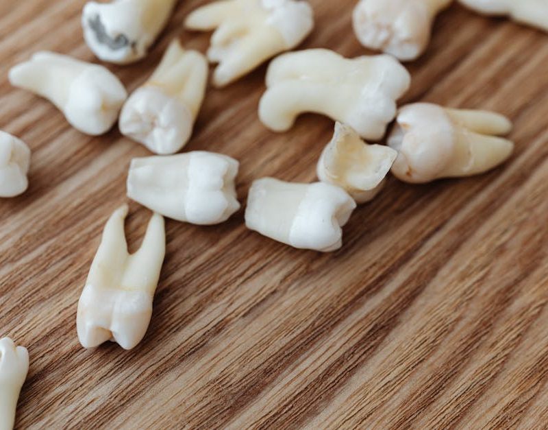 extracción muelas del juicio