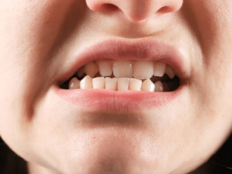 mandíbula desviada tratamiento