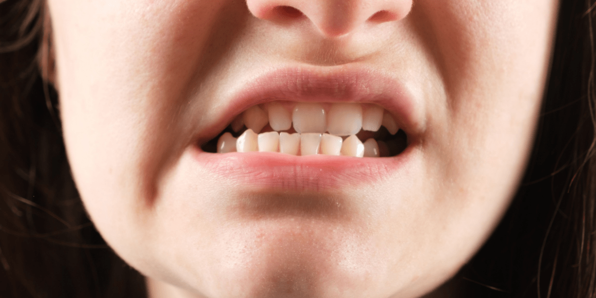 Mandíbula desviada: causas, consecuencias y tratamiento con cirugía ortognática en Barcelona