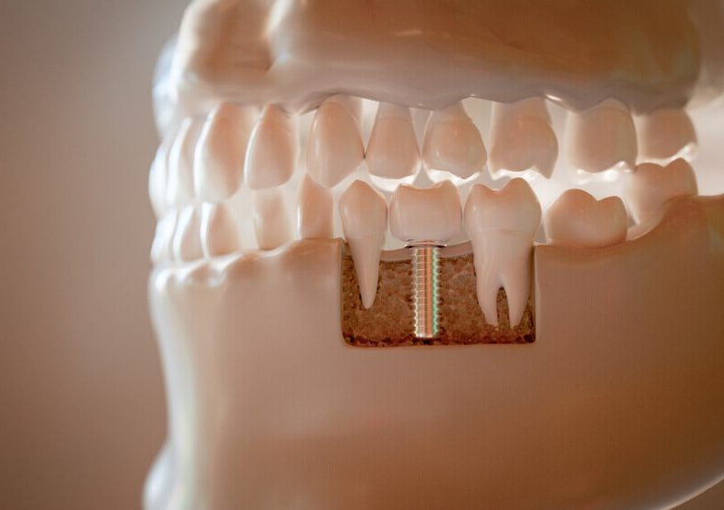 ¿Qué tipos de implantes dentales existen y cuál es el más adecuado?