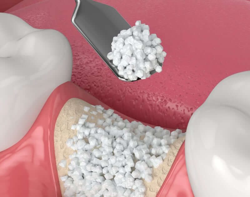 ¿Qué es un injerto óseo dental y cuándo es necesario?
