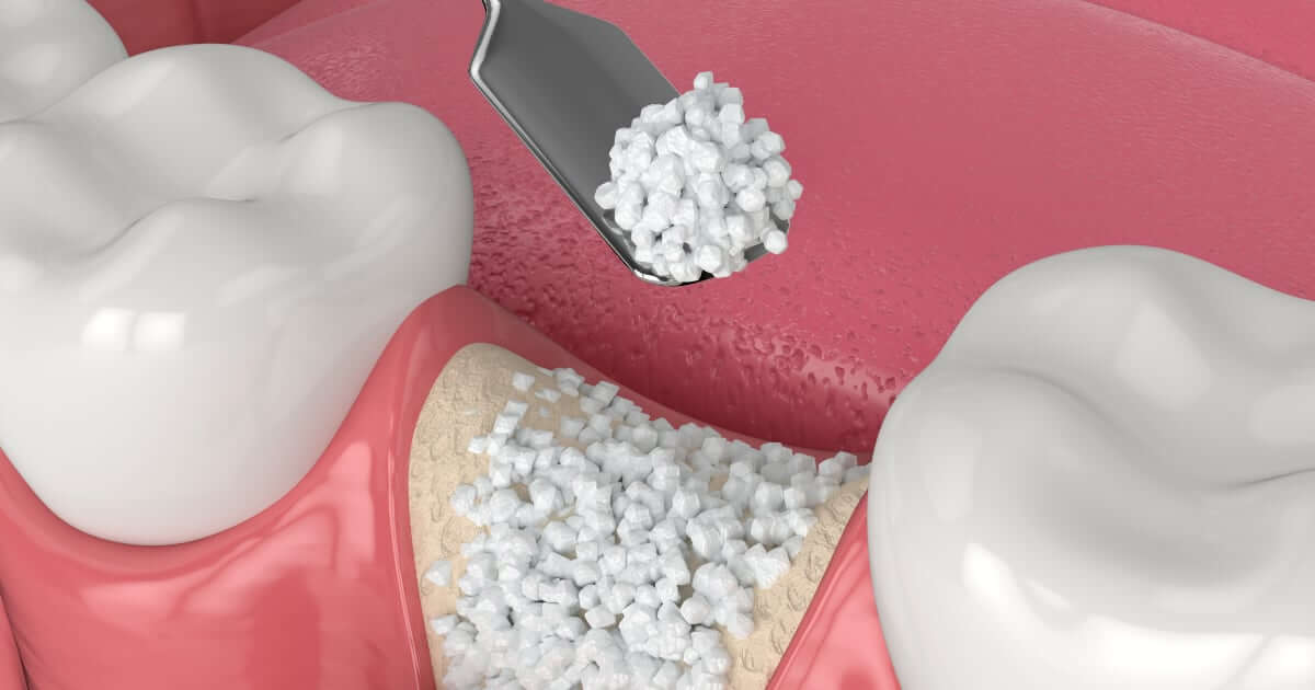 ¿Qué es un injerto óseo dental y cuándo es necesario?